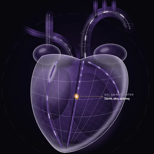 Semi-transparent 3D digital twin of a heart: the beating heart, blood flowing through the vessels and a marked narrowing in the left anterior descending artery.
